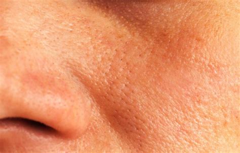 #1 Clogged Pores Symptoms & Causes