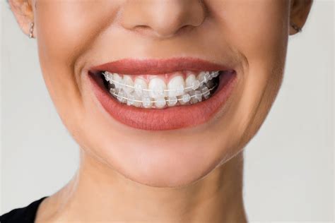 Ceramic Braces | Straight Teeth — South Beach Clinic