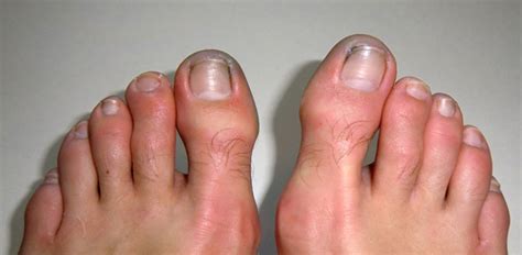 How to Tell if You Have Frostbite - Family Footcare