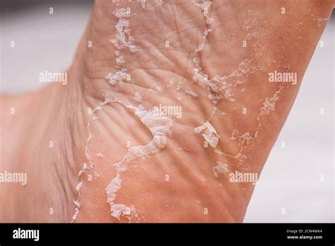 Skin peeling on the sole of a foot Stock Photo - Alamy