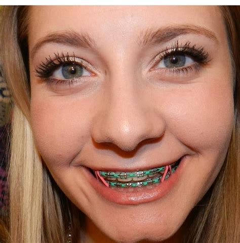 Best Colors For Braces