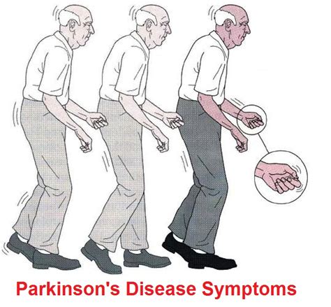 Parkinson's Disease: Signs And Symptoms, Diagnosis, Treatment And Prevention | Health And Beauty