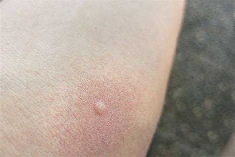 Common Symptoms, Causes, and Treatments for Spider Bites - Facty Health