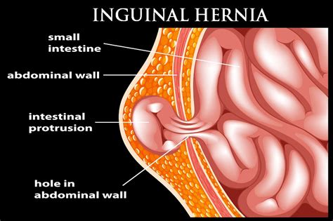 10 Surprising Symptoms of Inguinal Hernia | Dr. Abhijit Gotkhinde