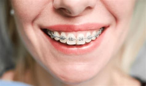 Advantages and Disadvantages of Metal Braces. | Grant Orthodontics