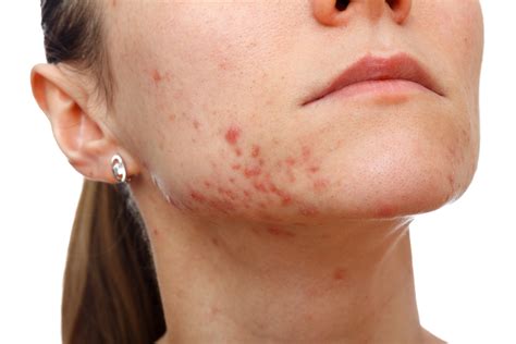 Acne Papules: Causes, Treatments, Natural Remedies, Do's and Don’ts