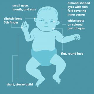 What is Down Syndrome? - Shreeansh- Fetal medicine center