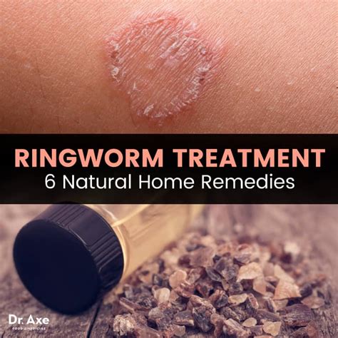 Ringworm Treatment: 6 Natural Remedies + How to Prevent It | Best Pure Essential Oils