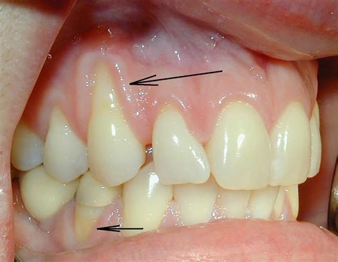 Gingival recession (Receding gums) | Ralev Dental Clinic