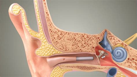 Maxum Middle Ear Implant | Texas ENT Specialists