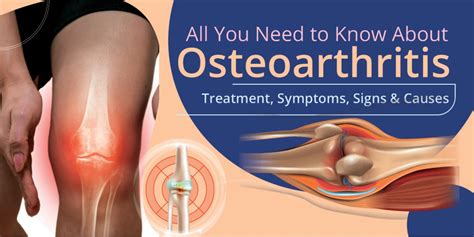 Osteoarthritis Treatment, Symptoms, Signs & Causes | Kayawell