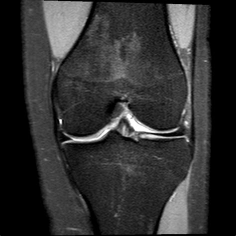 Normal Knee Mri Scan