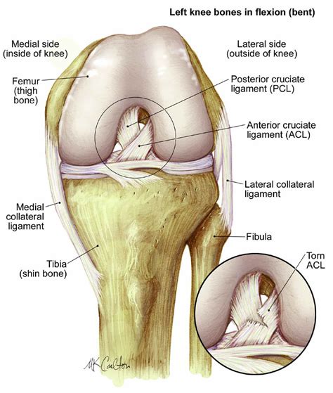 Torn acl symptoms - simplyharew