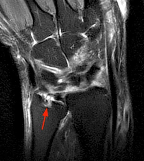 Rheumatoid Arthritis Knee Mri