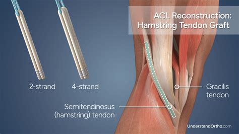 Torn ACL Reconstruction (Hamstring Graft) – UnderstandOrtho™