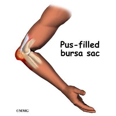 Olecranon Bursitis | eOrthopod.com