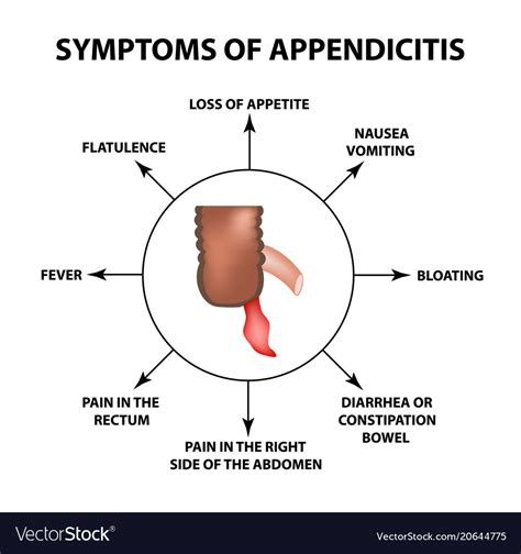 Symptoms Of Appendicitis Inflammation Appendix Vector Image | The Best Porn Website