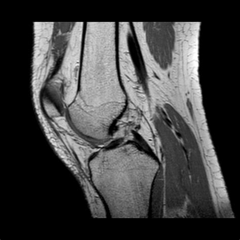 Knee Muscle Anatomy Mri - Knee Dislocation Wikipedia