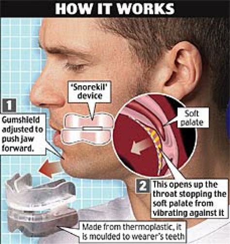 Best Anti-Snoring Mouthpieces - Reviews & Buying Guide