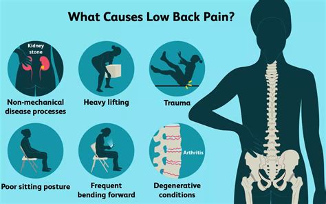 Lower Back Pain - Hip Osteoarthritis - Dr.S.Arumugam's Chennai Ortho