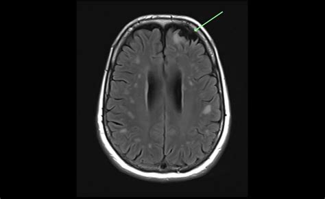 White Matter Hyperintensities on MRI - Artefact or Something Sinister?