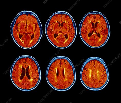 Dementia, MRI scans - Stock Image - M140/0433 - Science Photo Library