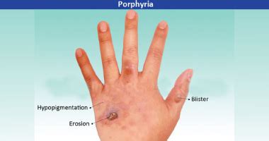 What is Porphyria? –Types, Causes, Symptoms, Treatment