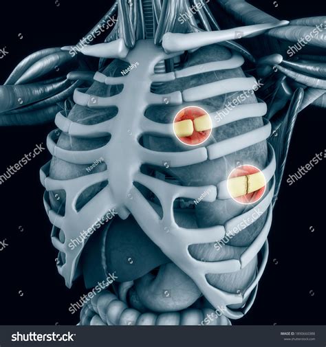 Anatomy Human Body Costochondral Separation Separated Stock Illustration 1890660388 | Shutterstock