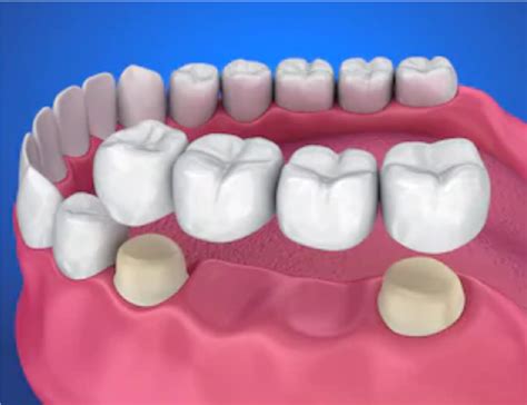 Bridges – Edgware Dental Practice