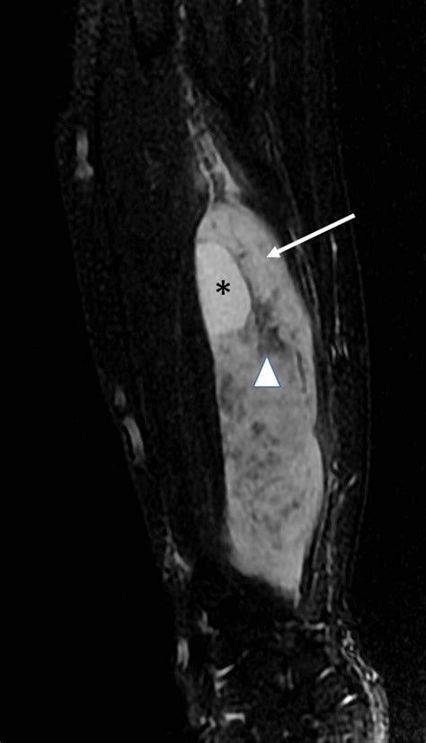 MRI of a synovial sarcoma of the right forearm showed three different... | Download Scientific ...