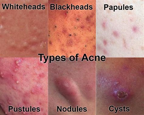 How Acne Forms, The Severe Pimples on Face and Other Part of Body - How Acne Forms