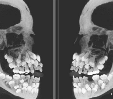 X-ray of baby’s skull : r/oddlyterrifying