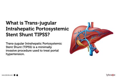 Transjugular Intrahepatic Portosystemic Stent Shunt Tipss: Causes, Symptoms, Treatment and Cost