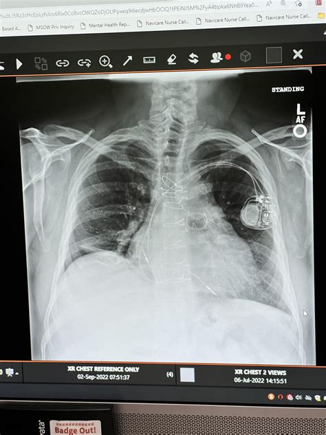 Before and After of Diaphragm Paralysis plication post 4th Open heart surgery : r/Radiology