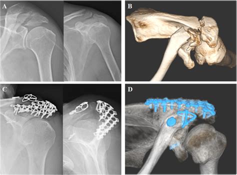 A: Left acromion fracture and ipsilateral distal clavicle fracture on... | Download Scientific ...