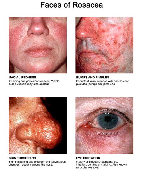 All About Rosacea: Signs & Symptoms and Treatment | Rosacea.org