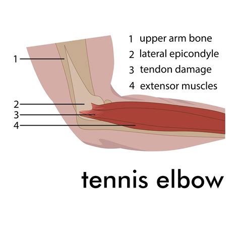 Tennis elbow treatment, What is it & how to cure it - Newcastle Physiotherapy