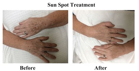 Age Spot Sun Spot Removal Raleigh | Skin Essence A Day Spa