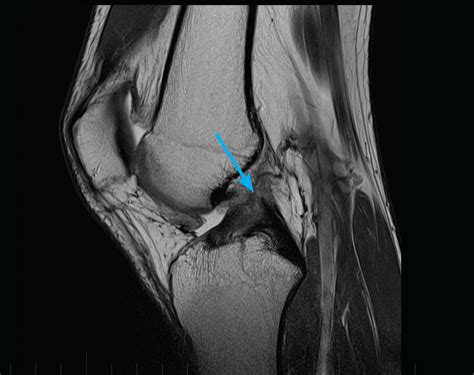 Knee, ACL & Meniscal Injuries Adult MRI Series