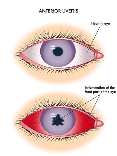 Uveitis, Eye Inflammation · Best Rated NYC Eye Doctor · Ophthalmologist