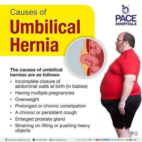 Umbilical Hernia Symptoms, Causes, Complications And, 45% OFF