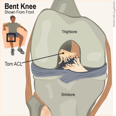 ACL Injury: Types of graft — The Club Physio