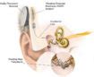 Middle ear implants - Clarity Hearing Solutions