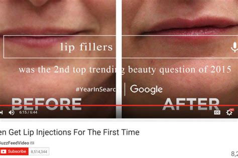 Collagen Lip Injections Archives - CandyLipz