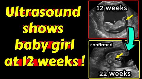 21 Week Ultrasound Girl