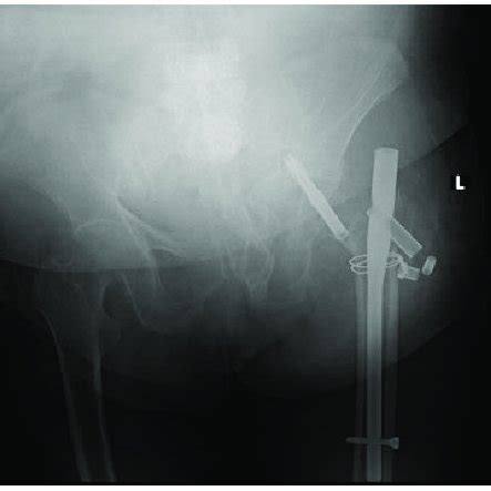 Plain radiograph showing that the proximal femoral nail antirotation... | Download Scientific ...