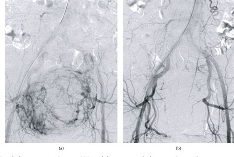 Figure 2 from Observation of Intramural Fibroid Expulsion on MRI after Uterine Artery ...