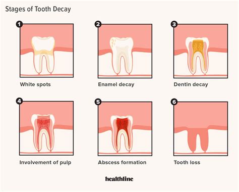 Mild Tooth Decay