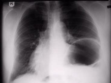 Paralysed diaphragm