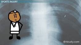 Costochondral Separation: Symptoms & Diagnosis | Study.com